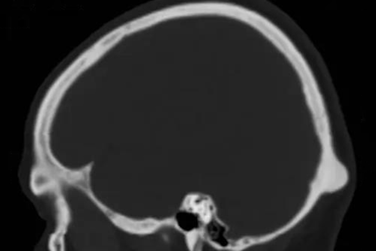 枕骨部位颅脑肿瘤图