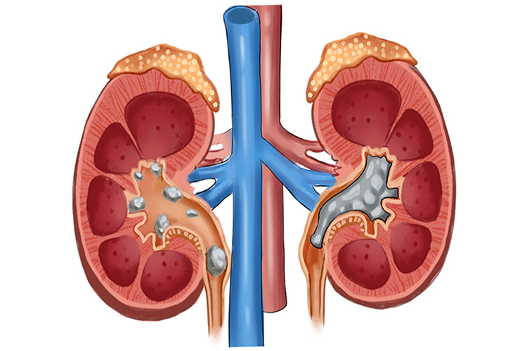 肾结石图