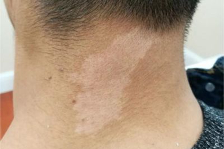 斑状白化病症状图 斑状白化病症状图
