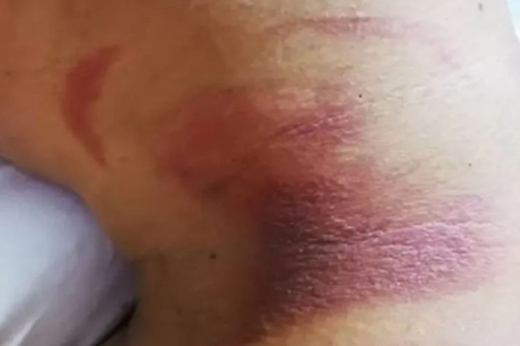 Ⅰ度烧伤后颈紫红图 Ⅰ度烧伤后颈紫红图