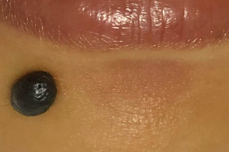 黑色素痣手术切除前图