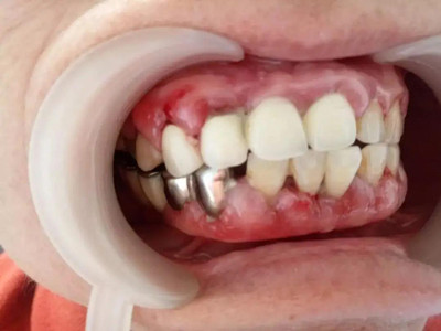 药物性牙龈肥大的症状和图片 - 有来医生