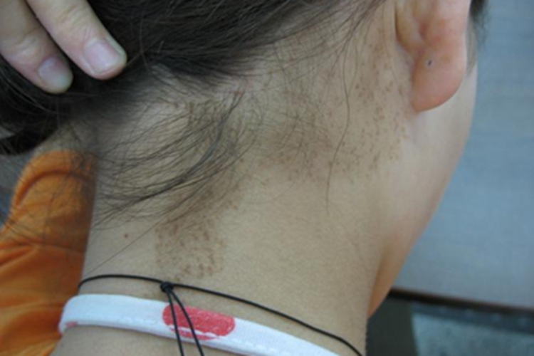 日光性雀斑样痣后颈症状图 日光性雀斑样痣后颈症状图