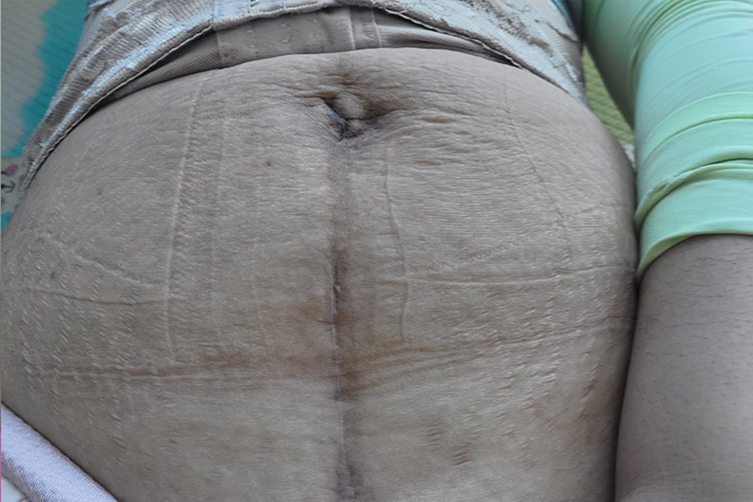 剖腹产白色瘢痕图