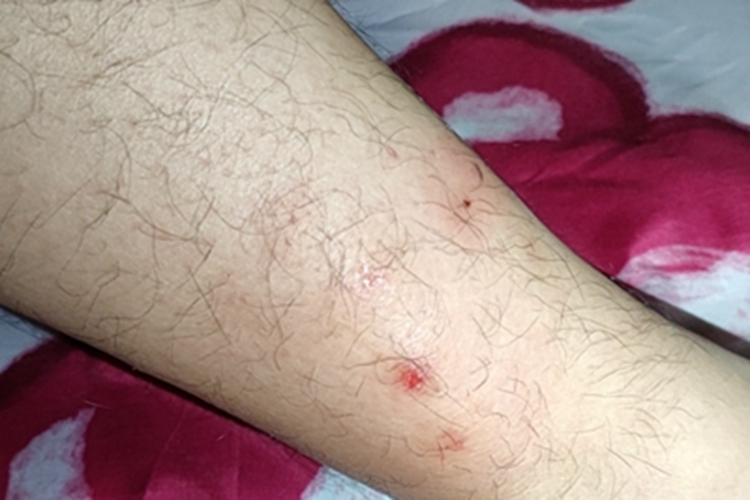 蚁蜇伤小腿破溃糜烂图