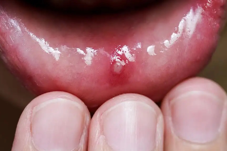 口腔溃疡初期图