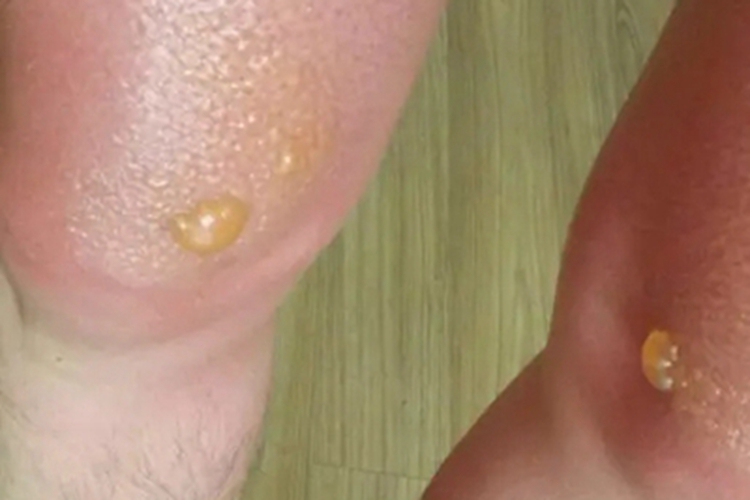 光接触性皮炎大腿水疱图