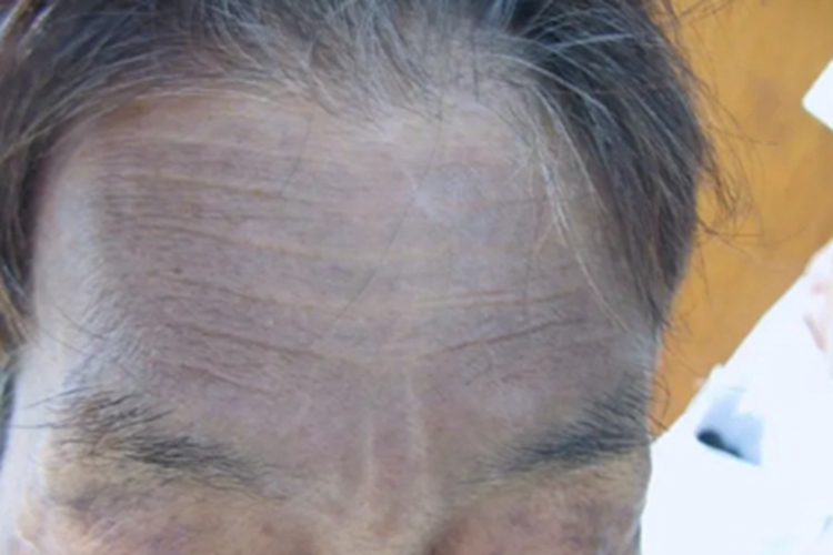 皮肤黑变病前额皮肤发黑图