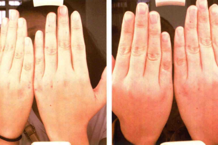 血管角皮瘤激光治疗一次前后图