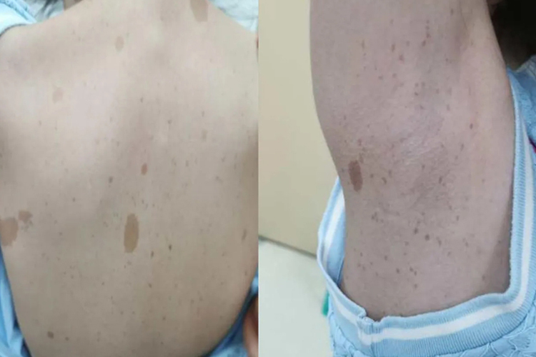 多发性神经纤维瘤咖啡牛奶斑图