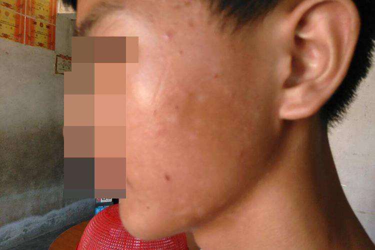 花斑糠疹脸上黑斑图