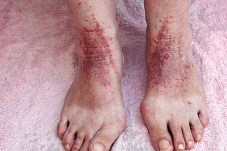 慢性湿疹脚背结痂图