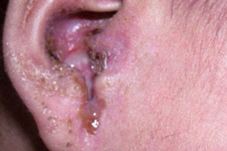 外耳湿疹耳朵流脓结痂图 外耳湿疹耳朵流脓结痂图