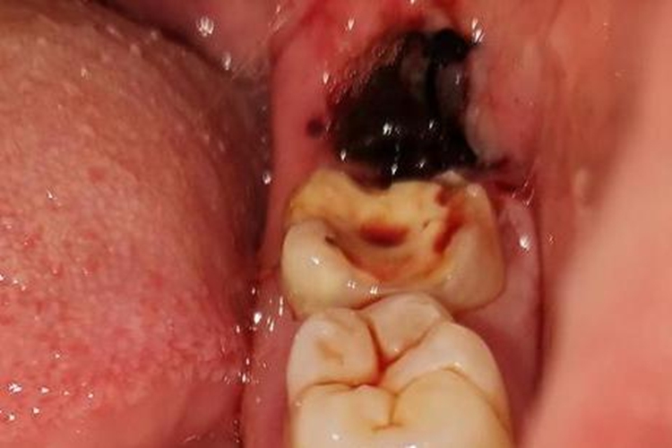 智齿拔除后创口充满血液图