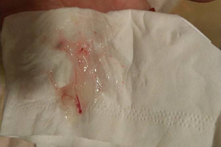 化脓性鼻窦炎鼻腔血丝图