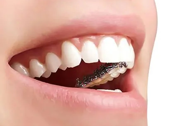 传统舌侧矫治器图