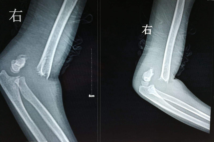 屈曲型肱骨髁上骨折图
