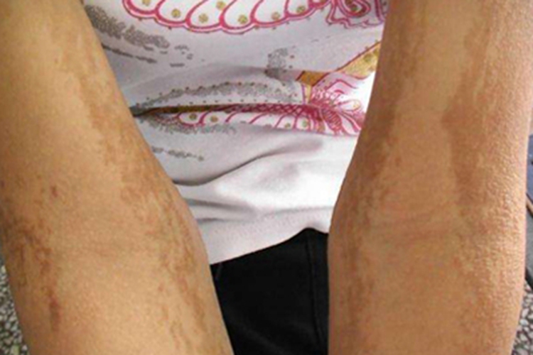 表皮痣胳膊斑图