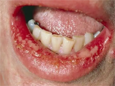 牙龈坏死症状图片图片