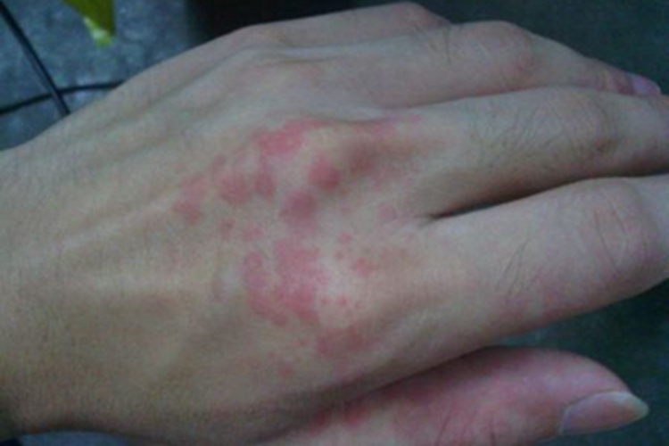 革螨皮炎手背红色斑疹图