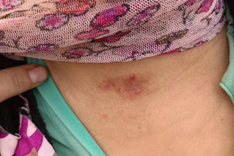 日光性皮炎前颈红斑图