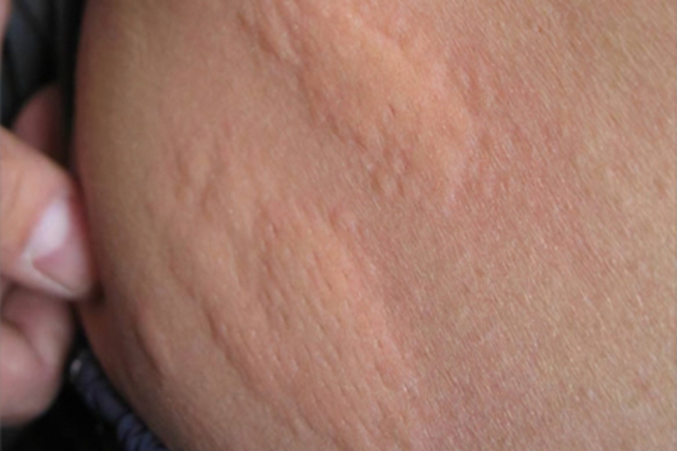 冷接触性荨麻疹腹部风团图