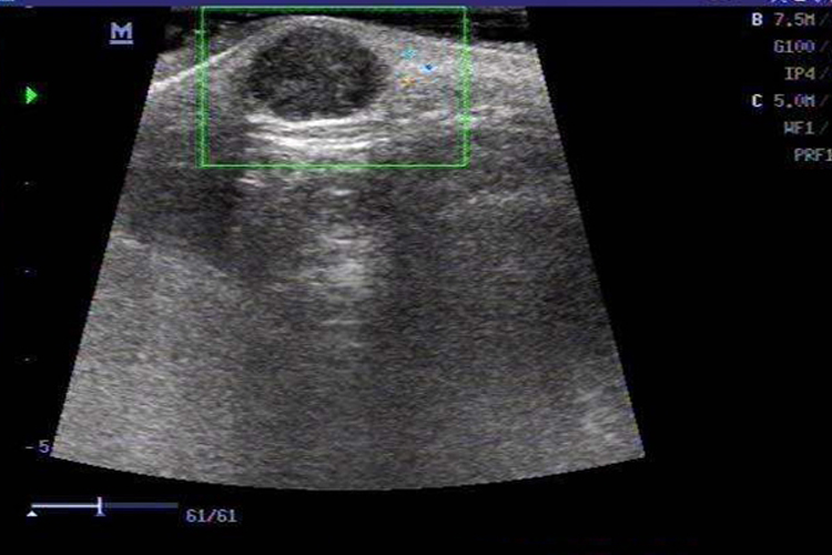 表皮样囊肿超声图片
