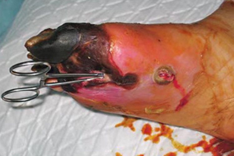 坏死性筋膜炎脚趾发黑图