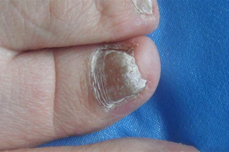 脚趾甲银屑病图