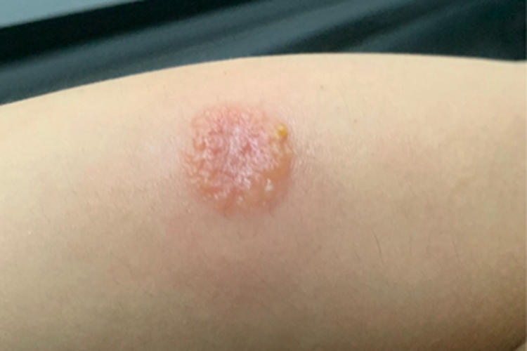 急性接触性皮炎胳膊渗液图 急性接触性皮炎胳膊渗液图