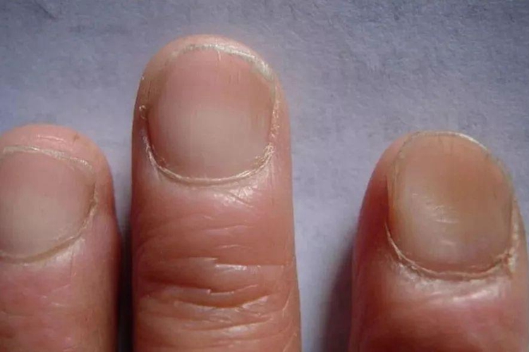 单个指甲外翻图 单个指甲外翻图