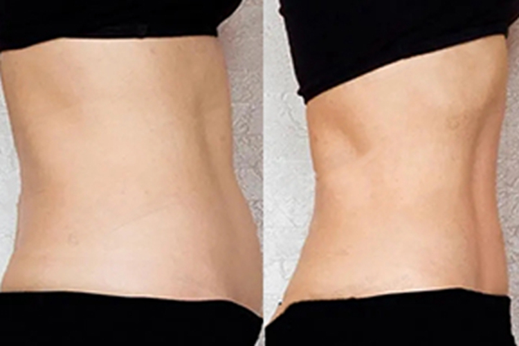 腰腹吸脂图