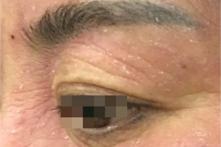 血管萎缩性皮肤异色病眼周症状图