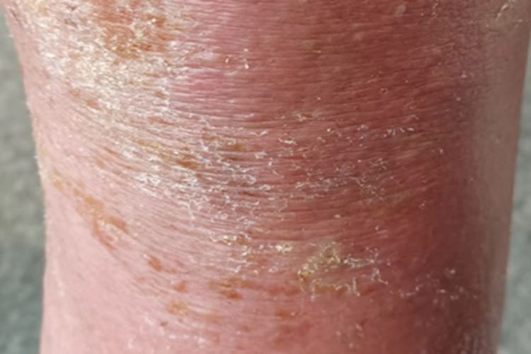 慢性接触性皮炎脱皮图 慢性接触性皮炎脱皮图