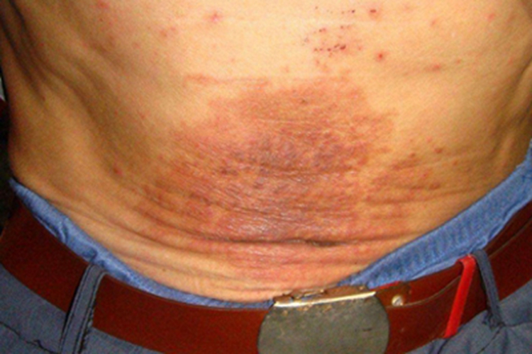 镍皮炎下腹红斑图 镍皮炎下腹红斑图