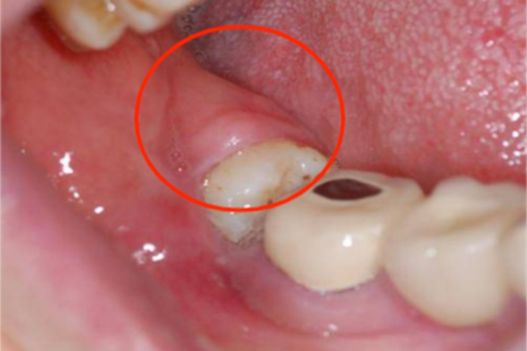 智齿冠周炎大包图 智齿冠周炎大包图