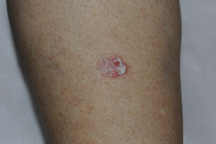 日光性角化病胳膊症状图 日光性角化病胳膊症状图