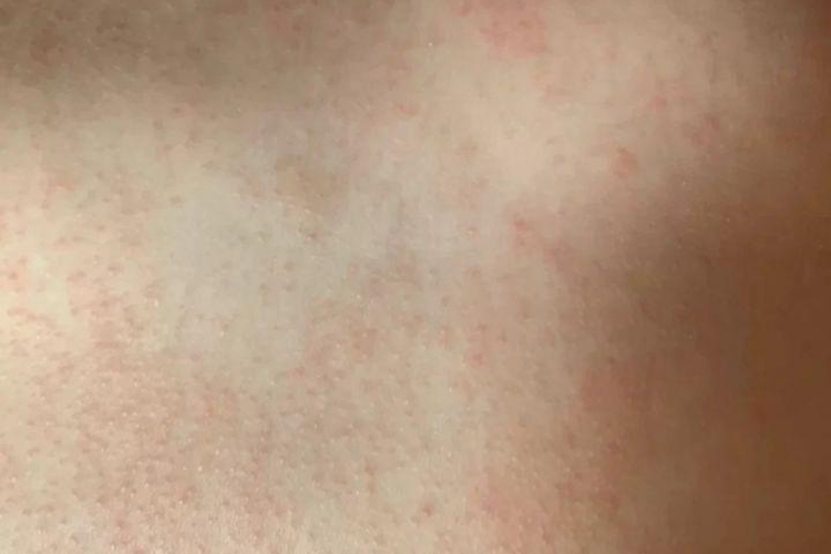 婴儿辅食过敏小疹子图