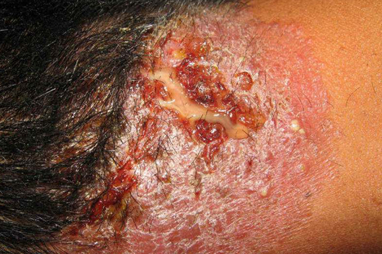 中医阴疽流脓图 中医阴疽流脓图