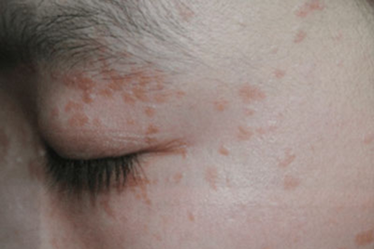 持久性豆状角化过度病眼周症状图