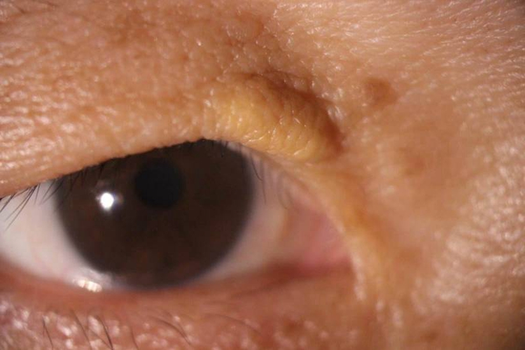 眼睑黄色瘤图 眼睑黄色瘤图