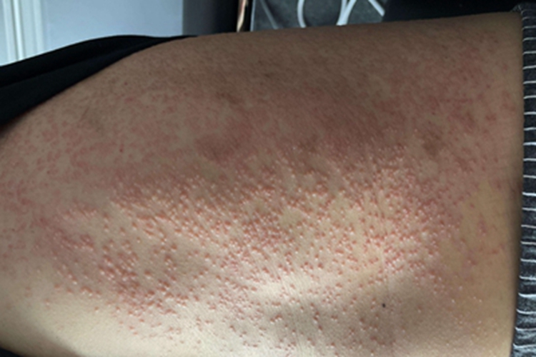 瘰疬性苔藓皮肤丘疹图