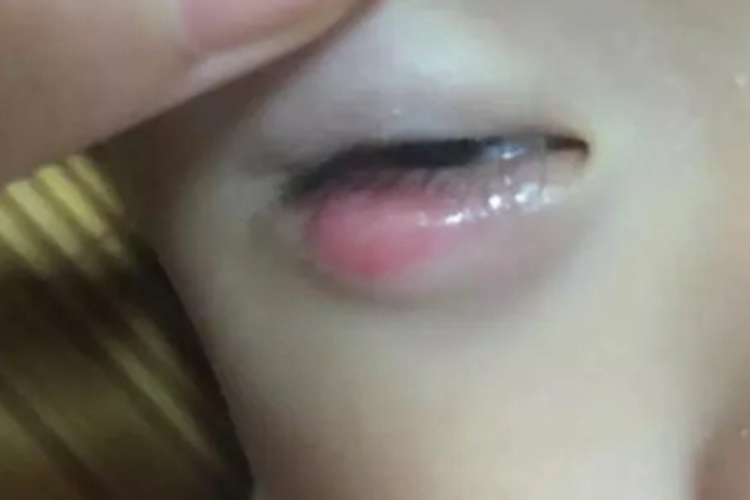 霰粒肿肿块图