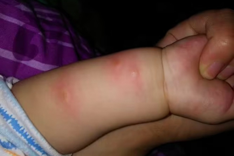 新生儿红斑胳膊有红肿疙瘩图