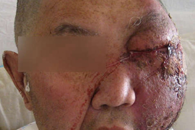 嗜酸性蜂窝织炎红肿图