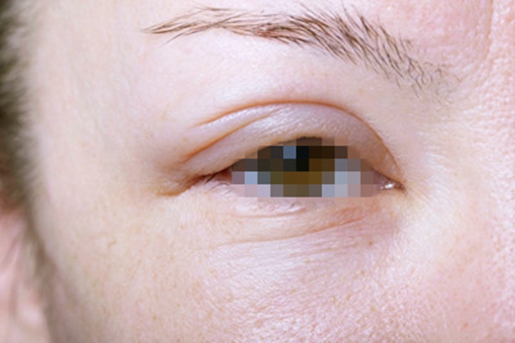 甲状腺功能减退症眼睑水肿图