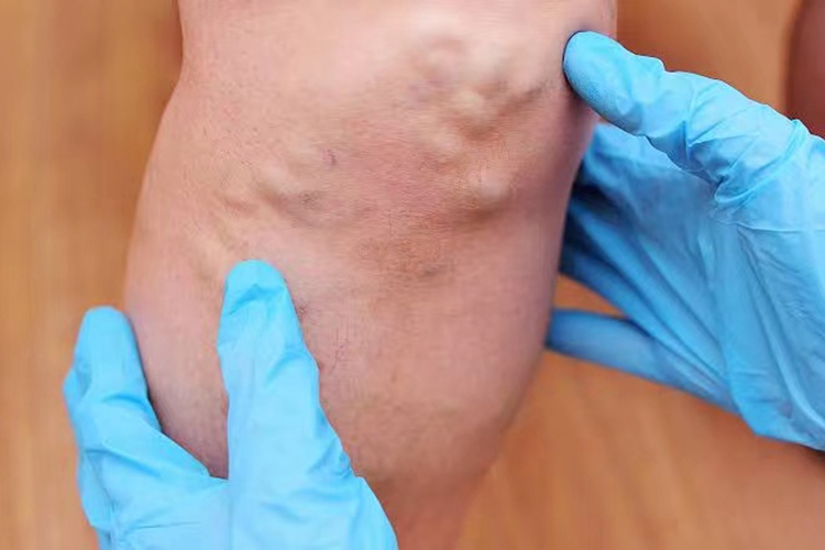 下肢深静脉血栓形成图