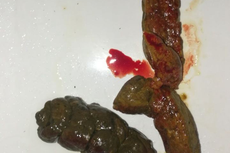结肠息肉便血图