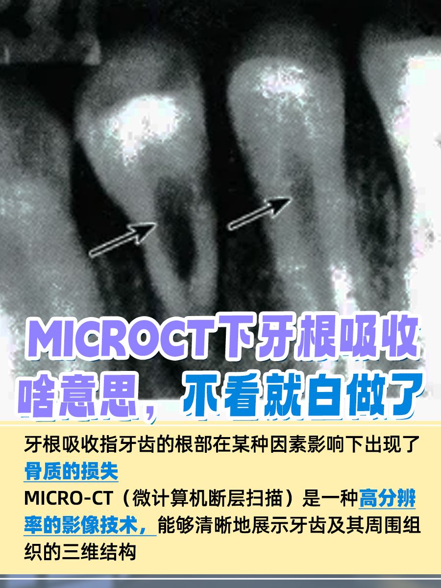 MicroCT下牙根吸收啥意思，不看就白做