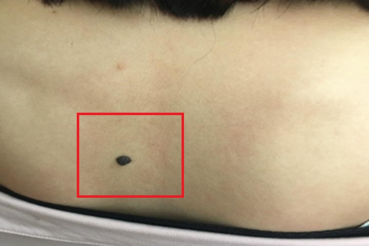 黑素细胞痣背部黑痣图 黑素细胞痣背部黑痣图